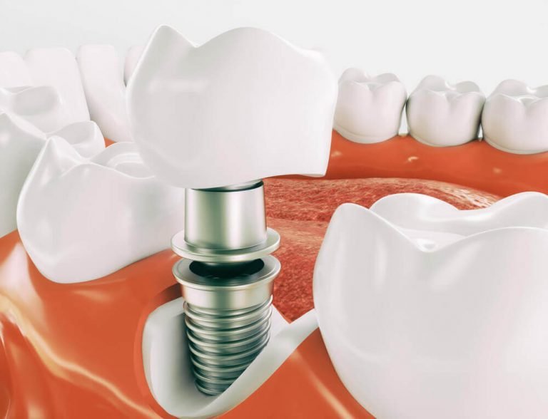 Dental Implants Brighton Replace Missing Teeth Hove